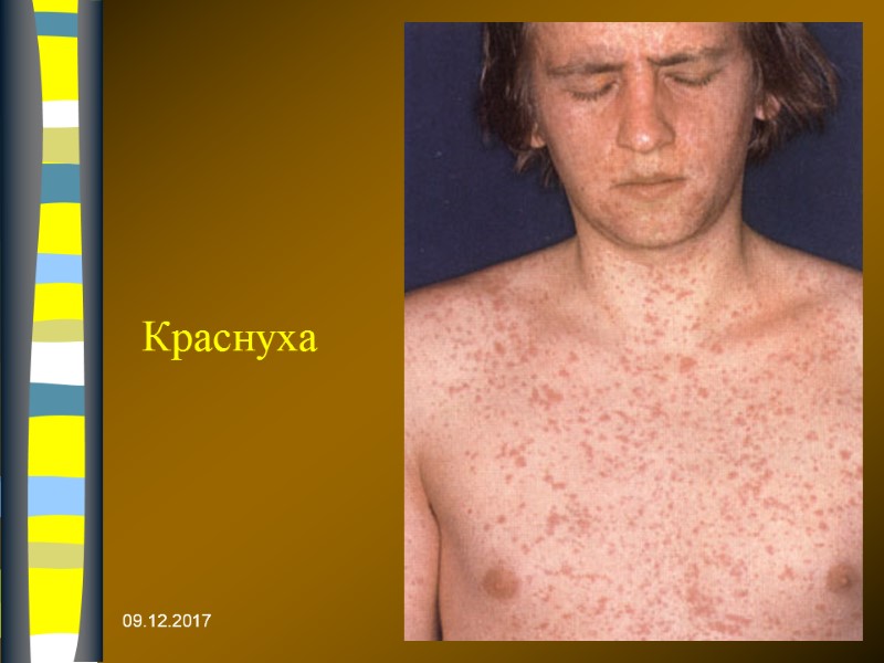 09.12.2017 Краснуха